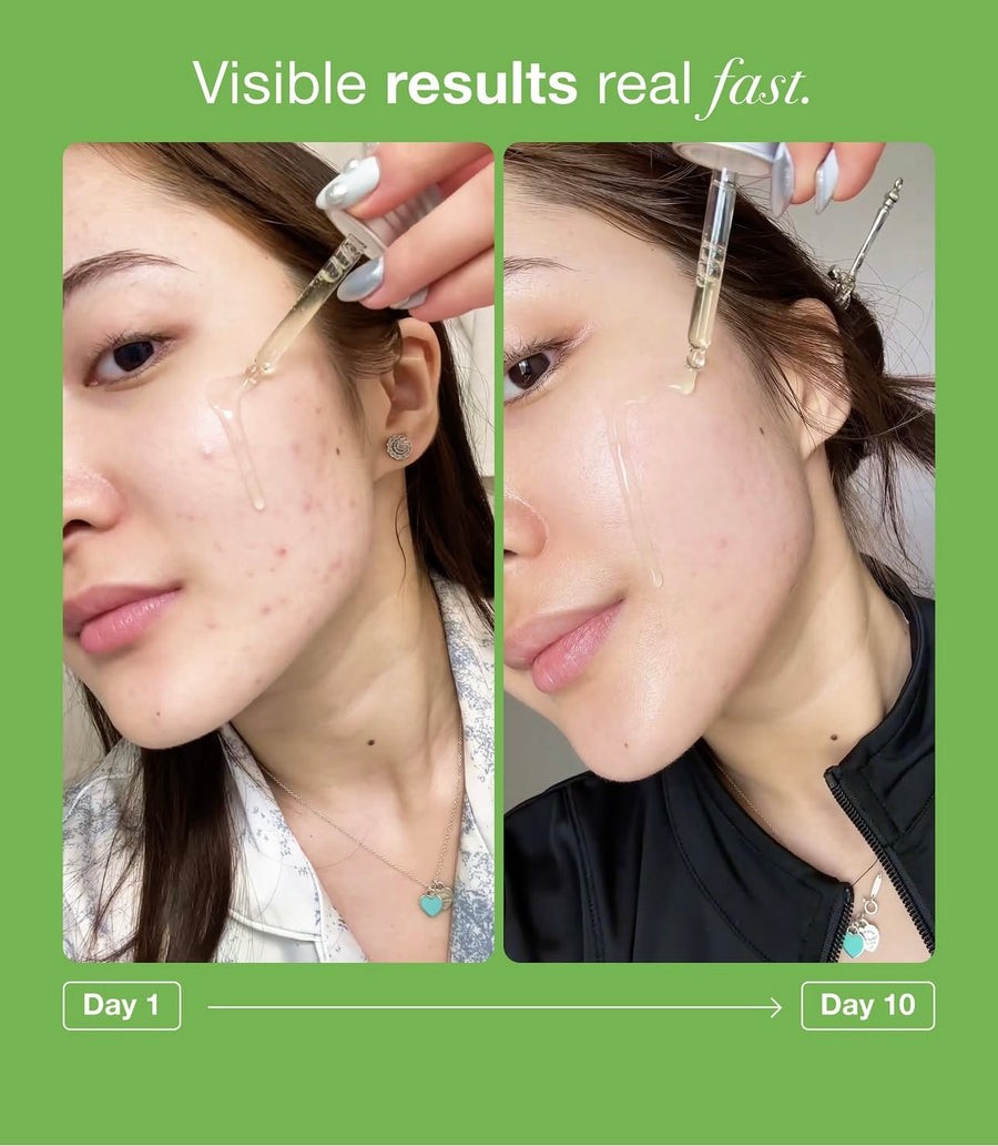ANUA AZELAIC ACID 10 HYALURON REDNESS SOOTHING SERUM 30ml | أنوا سيروم الآزليك اسيد  للبشرة