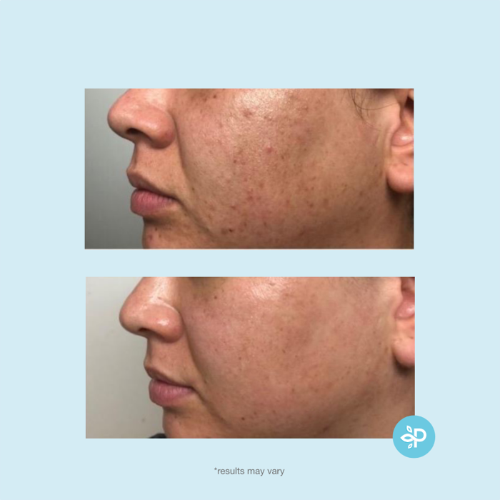 Perfect Image Revitaboost Peel Pads - 30pads | بيرفكت إيمج شرائح مقشر - 30 شريحة