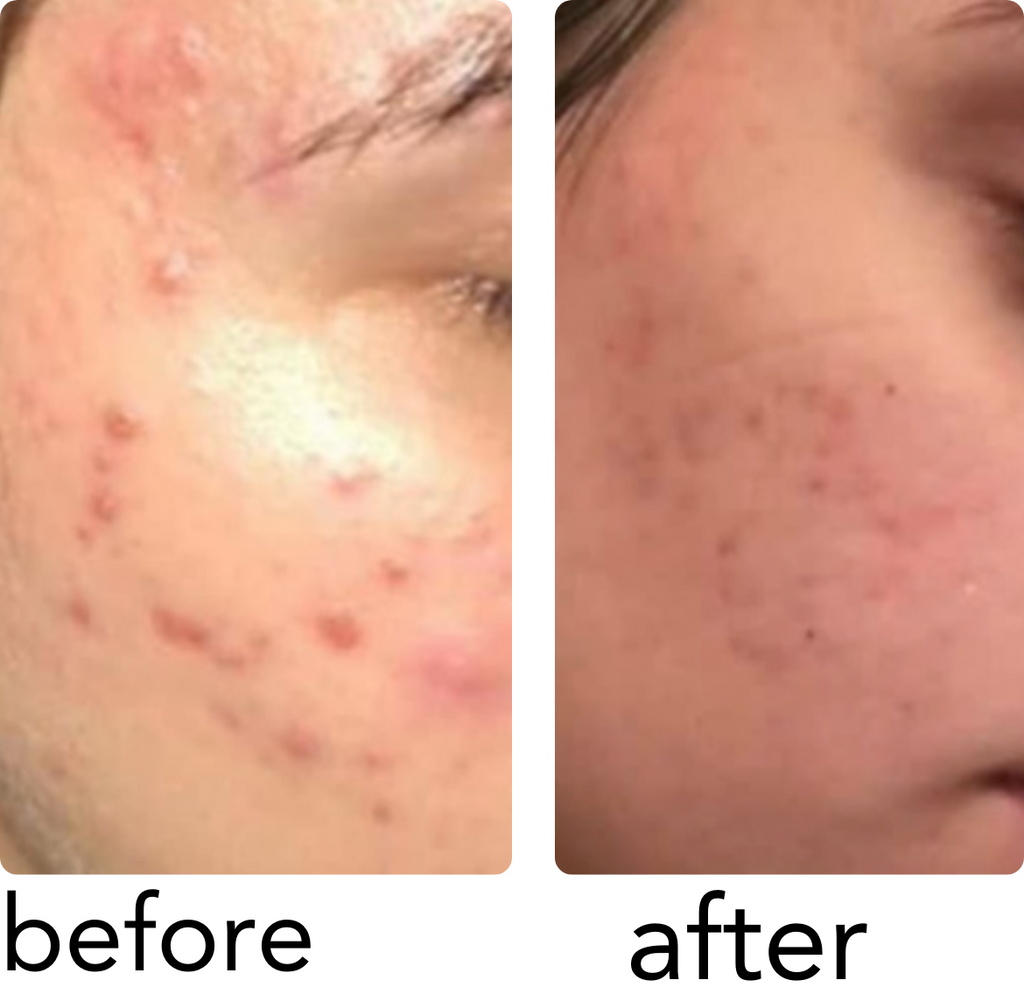 PanOxyl Acne Foaming Wash Benzoyl Peroxide 10% Max Strength - 156g | بانوكسيل غسول رغوي لحب الشباب البنزويل بيروكسايد 10% - 156 غرام
