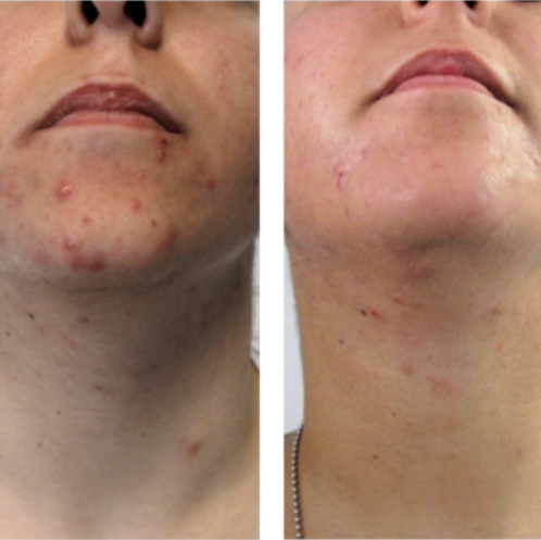 HYFaC Woman Active Mask Peel-Off Anti Imperfections - 15 Sachets | ايفاك ماسك مقشر للنساء - 15 قطعة