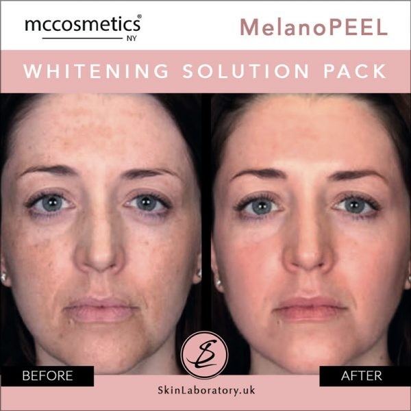 إم سي كوزمتكس امبولات تقشير التصبغات |   mccosmetics Melanopeel Ampoule